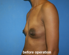 plastic-surgery-breast-augmentation
